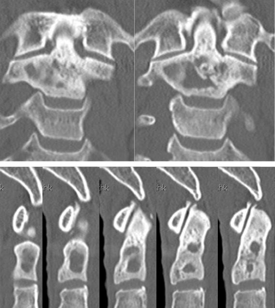 Figure 3 for case fibrous dysplasia ( RID3738 )